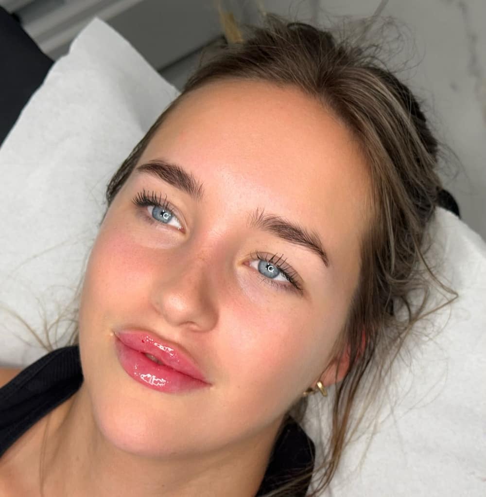 A soft, natural-looking lower-face and jaw result after dermal filler treatment at Lady Young's in Bracknell
