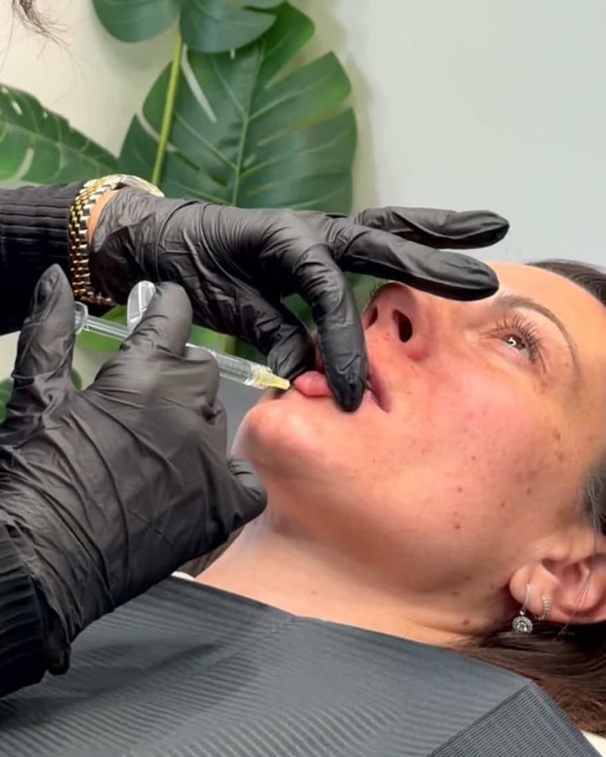 Safina Young placing lip filler with a fine needle for a client at Lady Young's in Bracknell