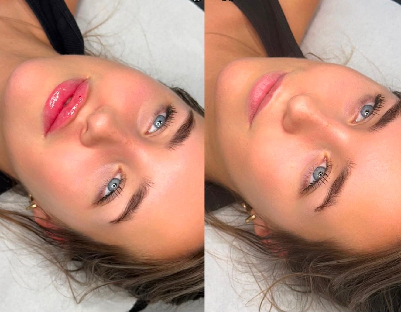 Before and after lip filler by Safina Young — subtle added volume with a soft, natural shape